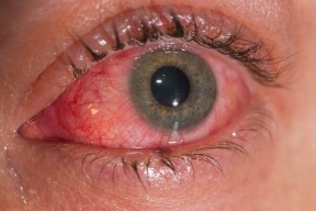 eyes damaged by chimney smoke